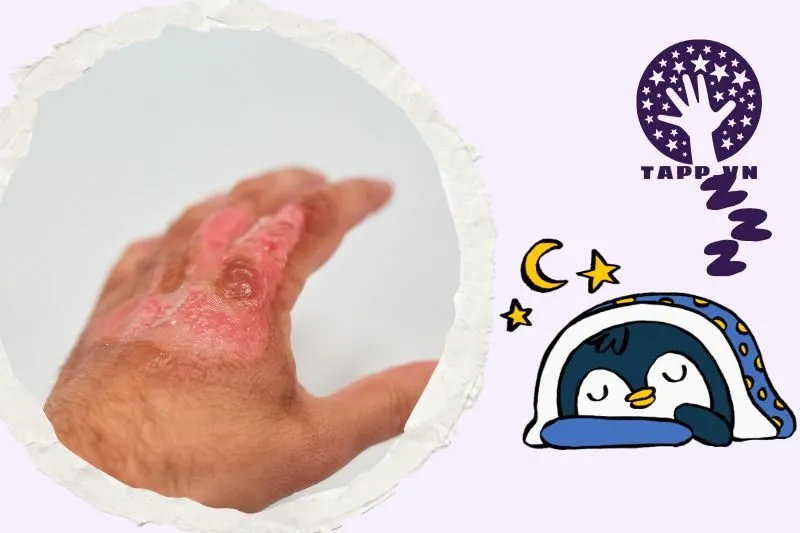 Ý nghĩa của việc nằm mơ thấy bị bỏng